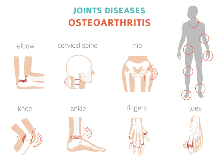 what-exactly-is-osteoarthritis-know-everything-about-it-v-cure