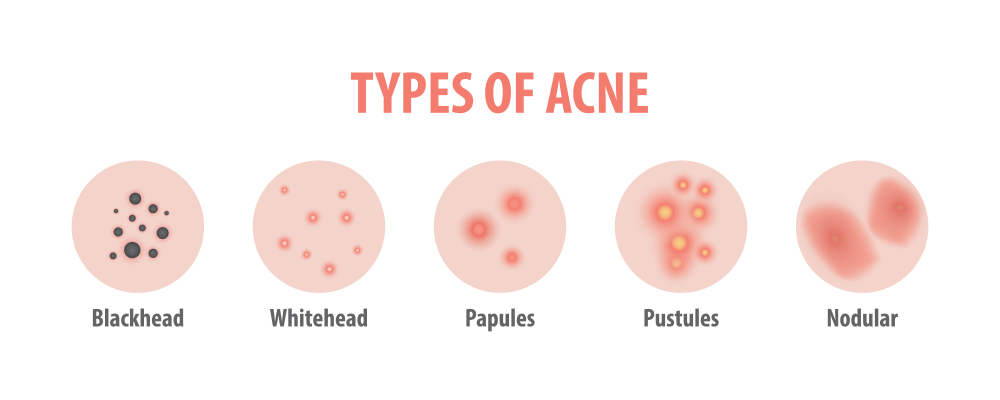 types of acne