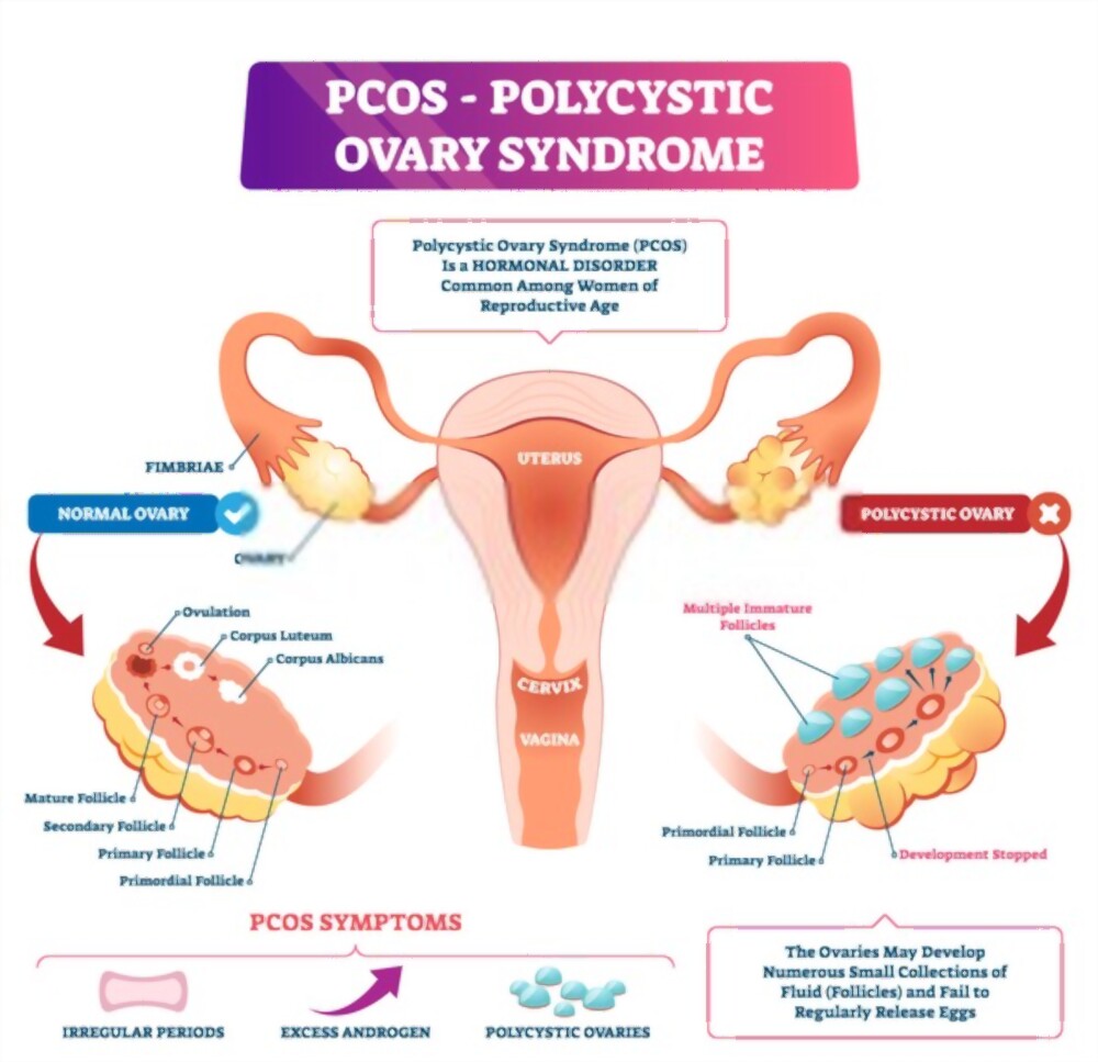 polycystic ovary syndrome