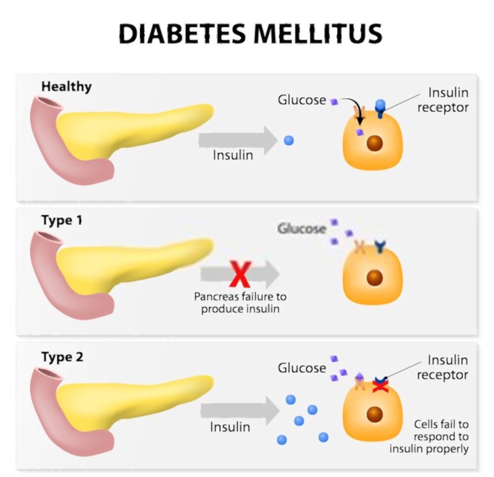 diabetes mellitus
