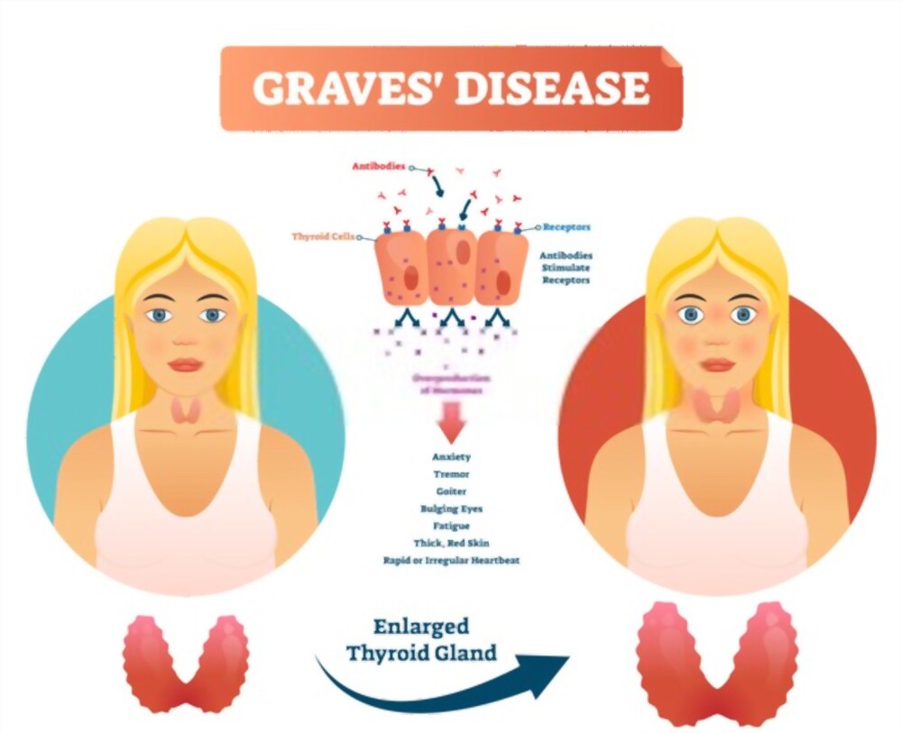 graves disease
