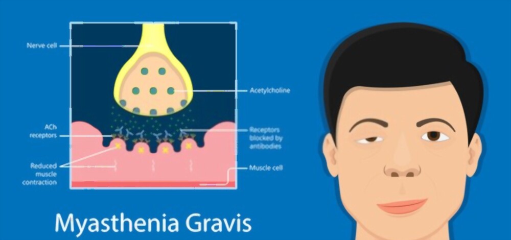 myasthenia gravis