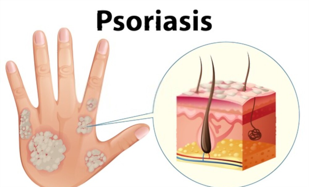 psoriasis
