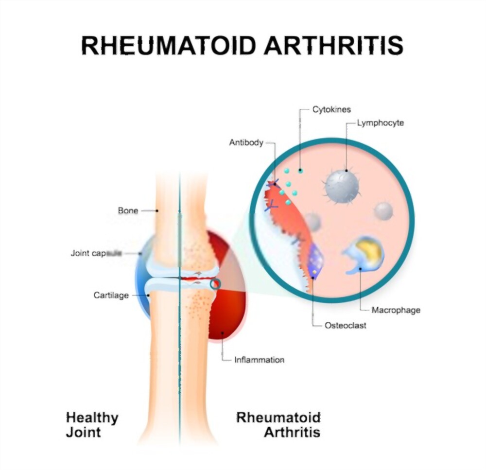 rheumatoid arthritis
