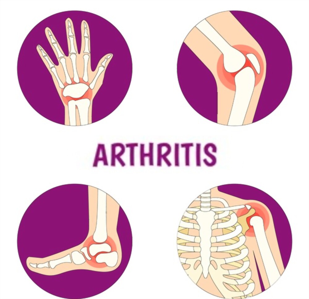 athritis 