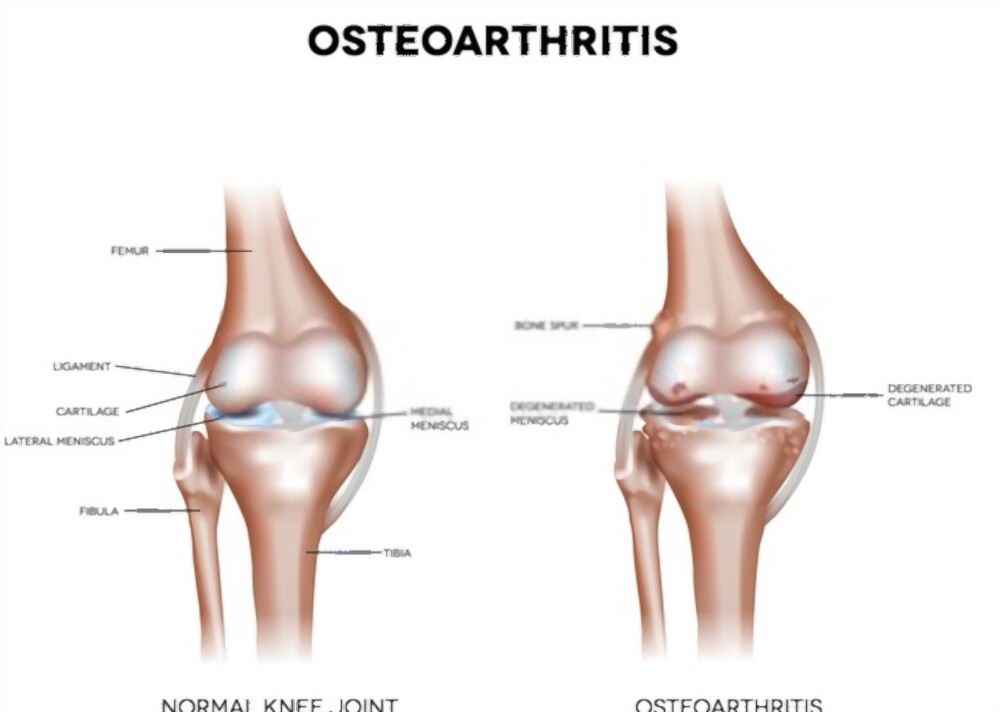 osteoarthritis