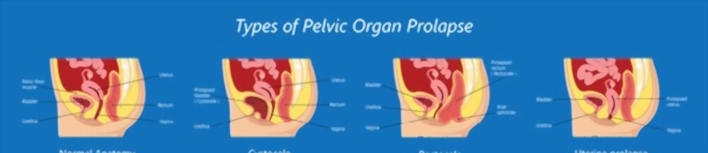 pelvic health- Vcurehealthcare