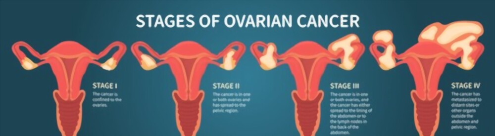ovarian ca- vcurehealthcare