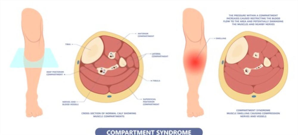 compartment- vcure