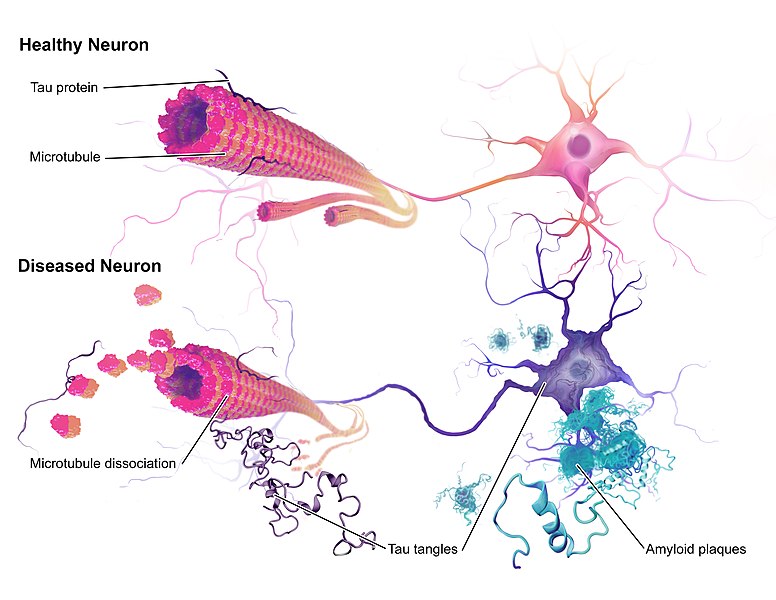 Alzheimer’s disease 