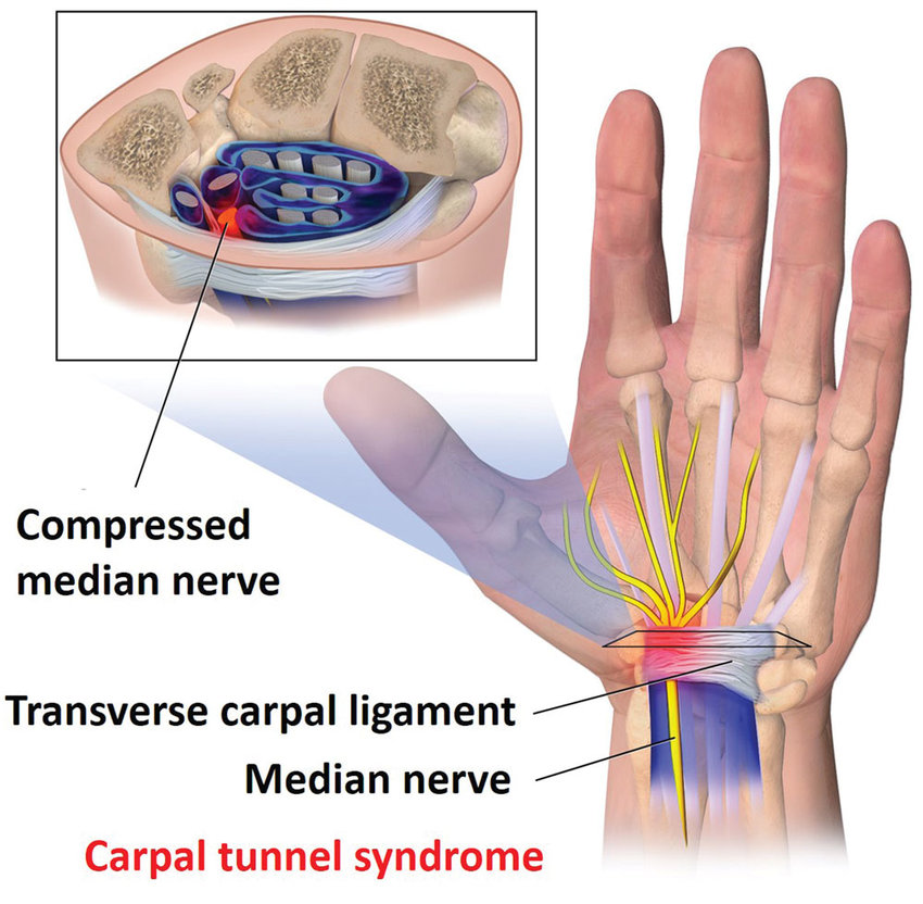 Hand pain from typing