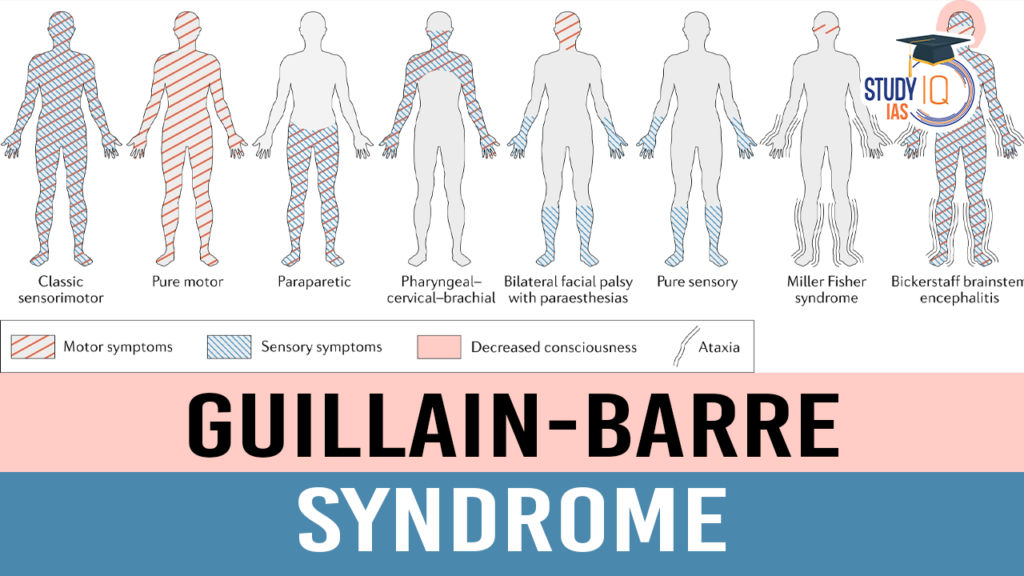 Guillain-Barre Syndrome