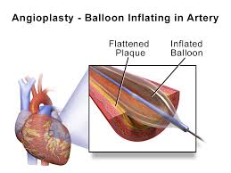 angioplasty