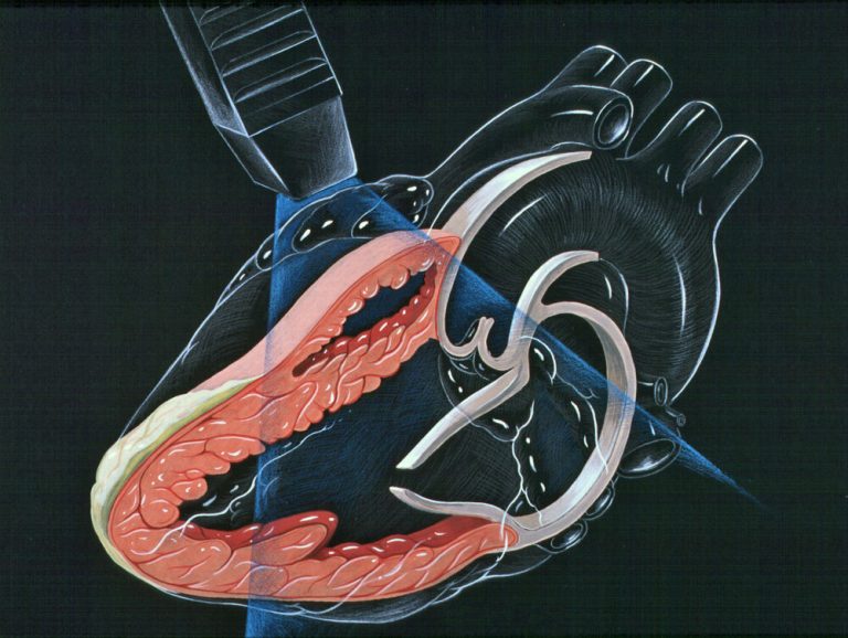 heart valve