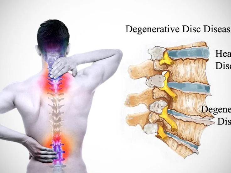 Degenerative disc disease- causes of neck pain