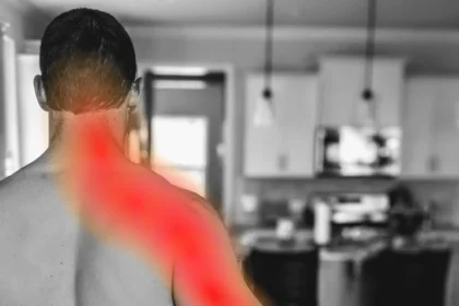 Cervical Radiculopathy