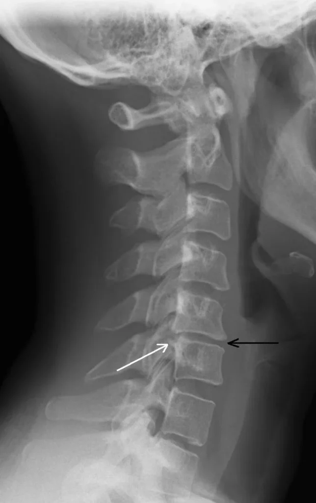 Cervical Degenerative Disc Disease