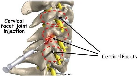 Cervical Facet Joint Pain injection