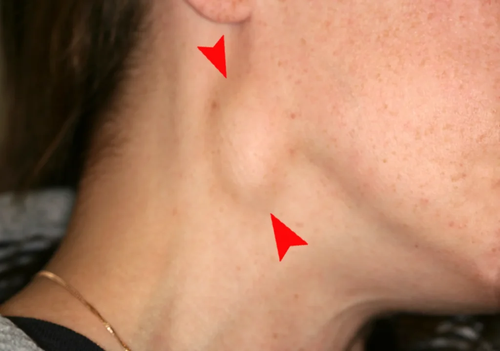 cervical lymphadenopathy