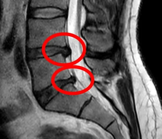 cervical disc herniation