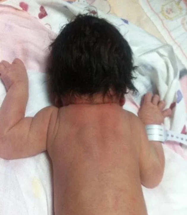 Klippel–Feil syndrome