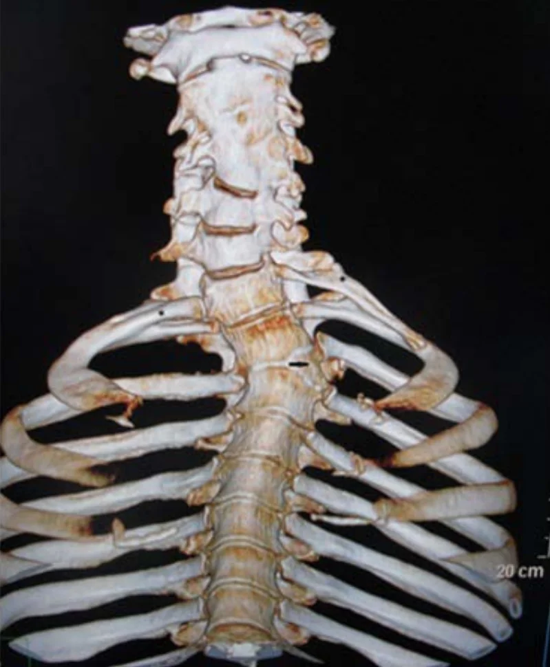 Klippel–Feil syndrome