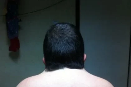 Klippel–Feil syndrome