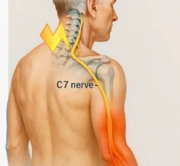 Pinched Nerve causing radiating pain