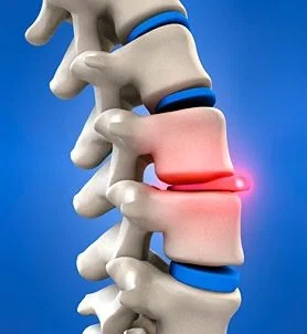 Disc herniation- causes of neck pain