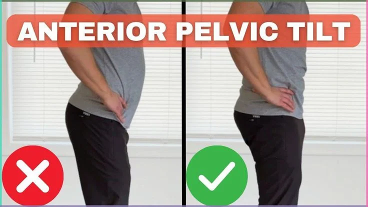 Anterior pelvic tilt