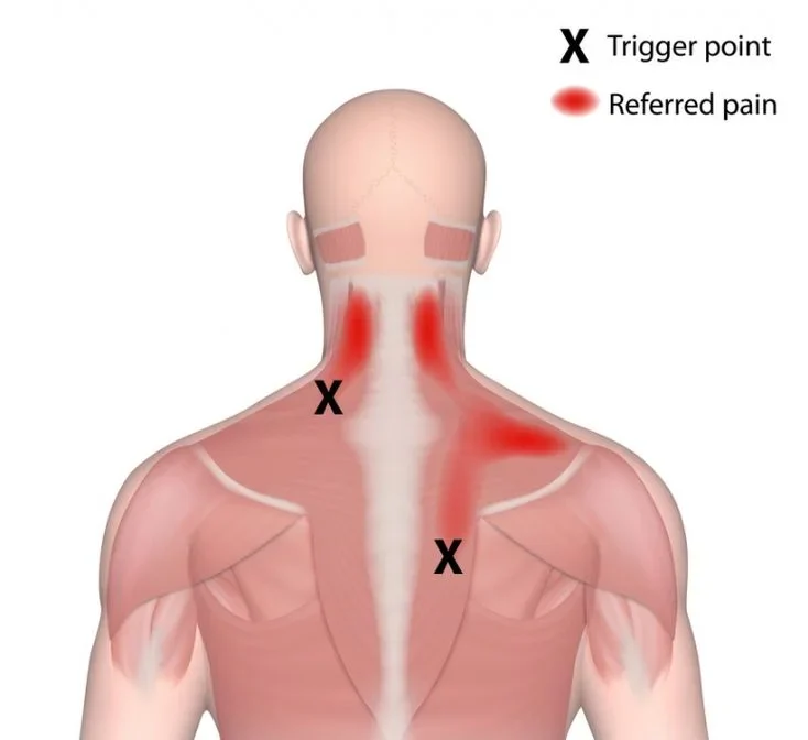 Trigger points muscles in neck