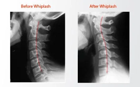Whiplash injury diagnosis