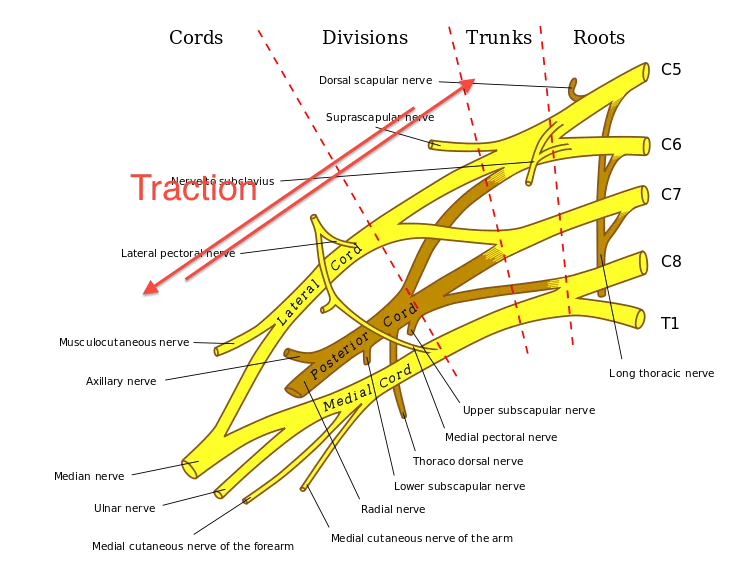 traction injury of Burners syndrome treatment
