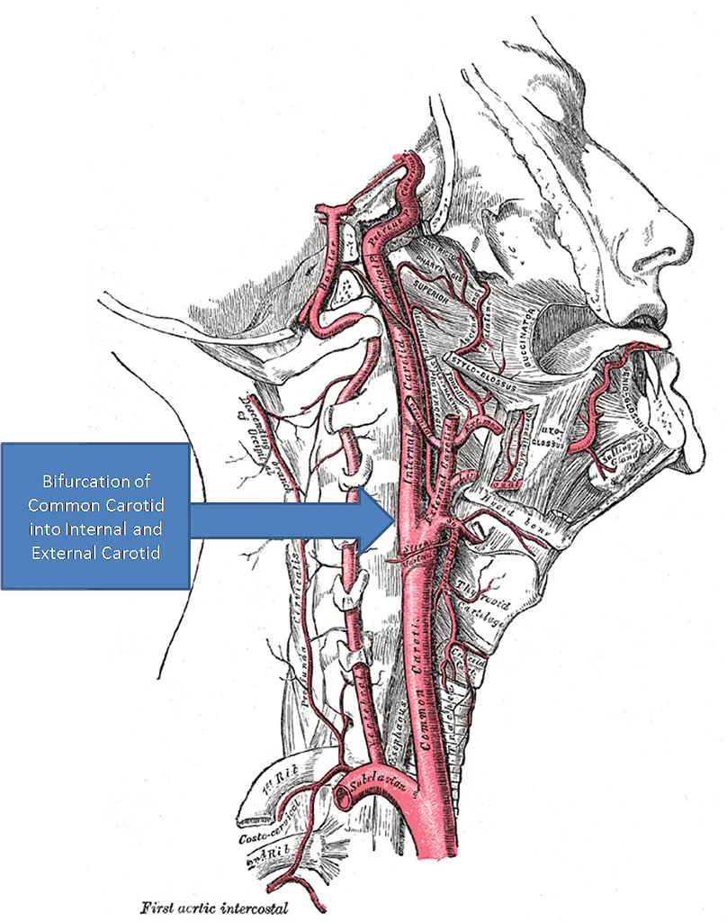 Carotidynia