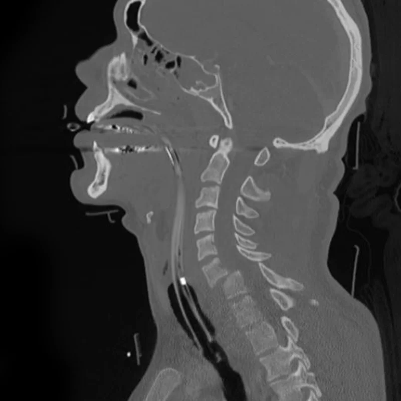 Cervical fracture spine Xray