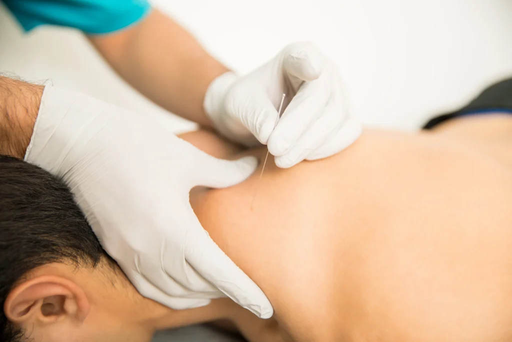 Dry needling for neck pain