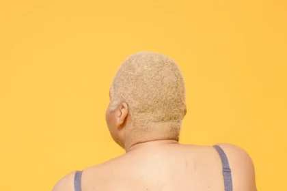 Buffalo Hump or neck hump