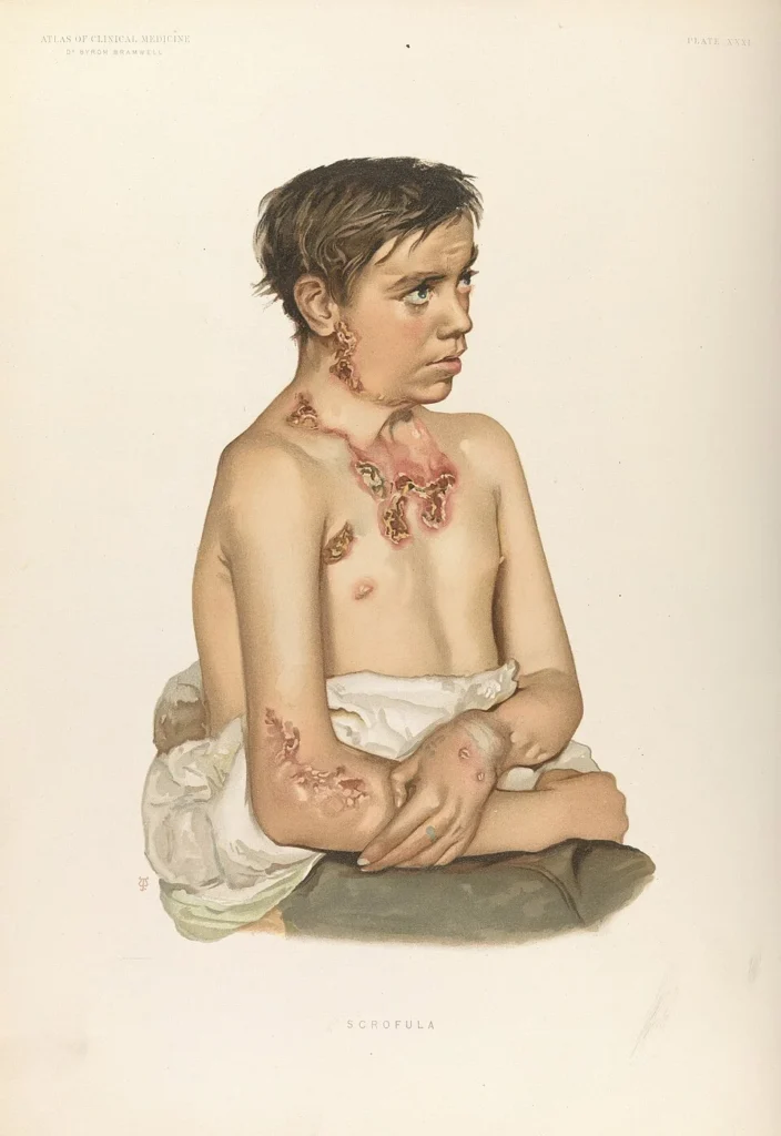 scrofuloderma