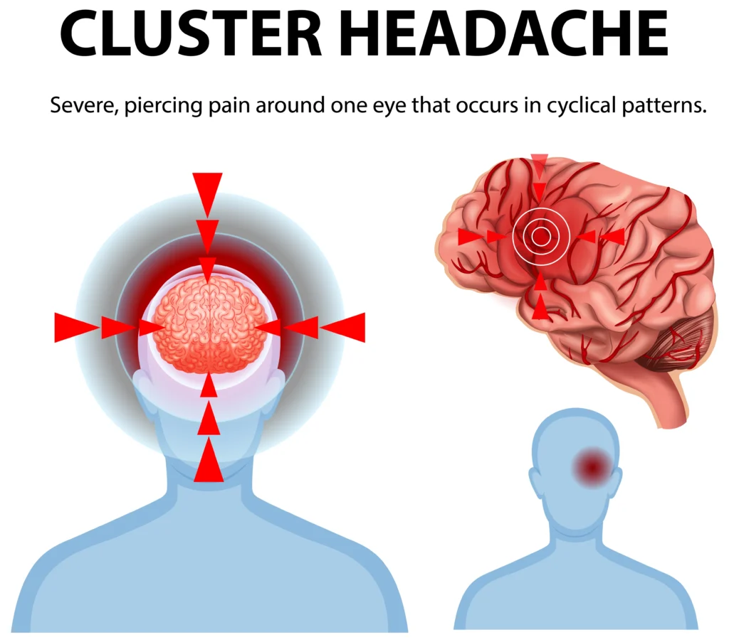 cluster headache early warning signs
