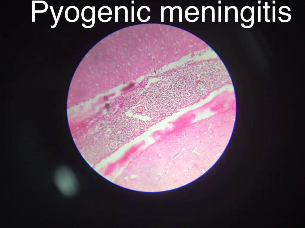 Pyogenic meningitis