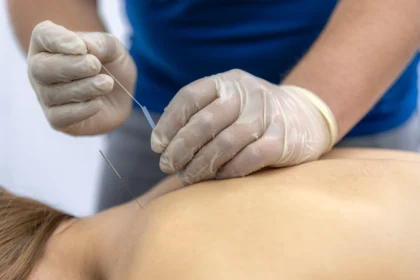 dry needling for headaches