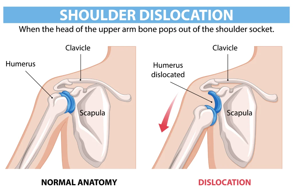 shoulder dislocation treatment at home