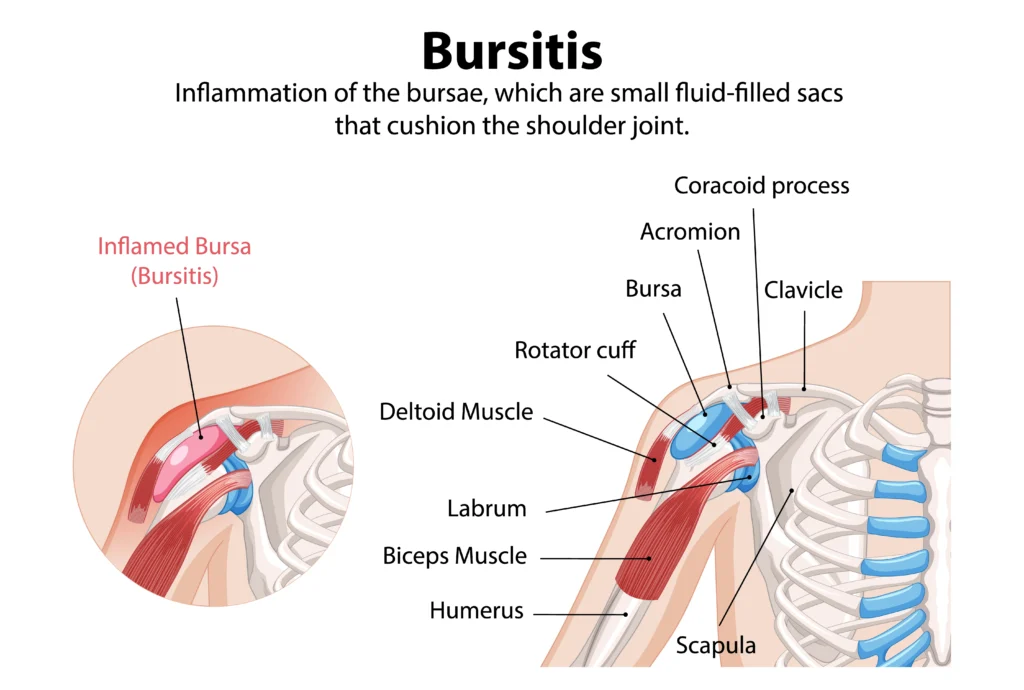 Shoulder bursitis treatment at home