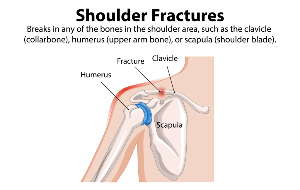 shoulder fracture treatment without surgery