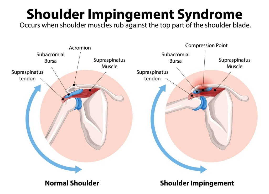 Shoulder impingement exercises at home