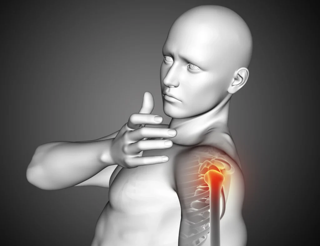 how to treat shoulder avascular necrosis