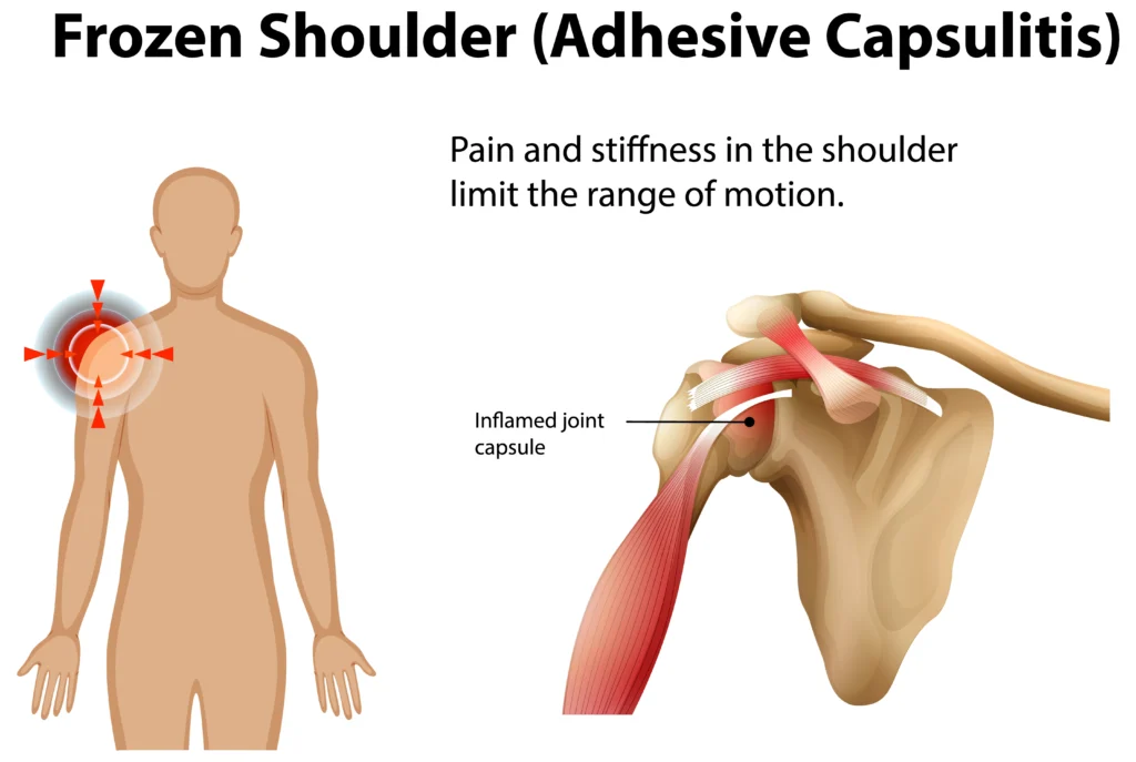 frozen shoulder early signs and symptoms