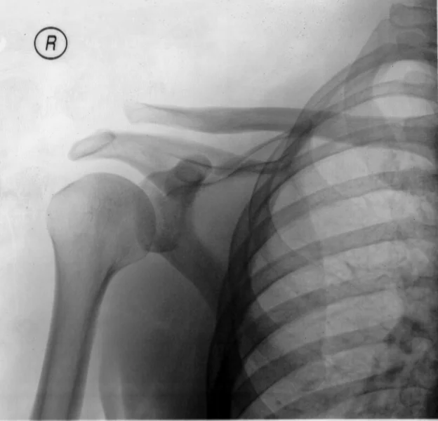 shoulder separation treatment