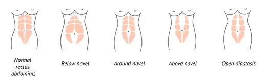 Diastasis Recti Recovery Without Surgery