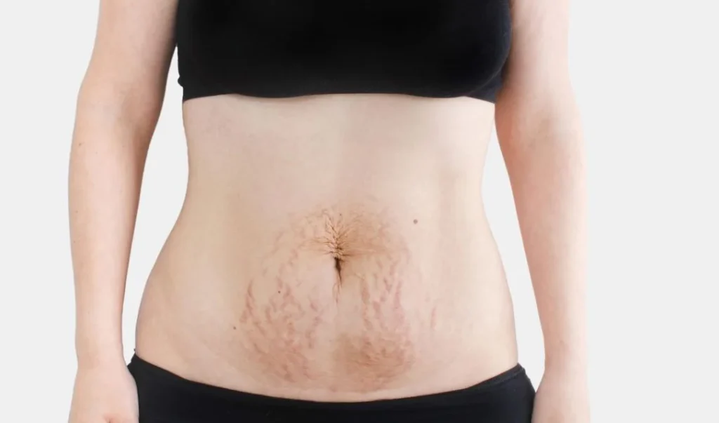 Diastasis Recti Recovery Without Surgery